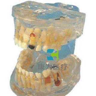“康为医疗”透明乳牙病理模型