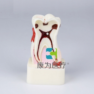 来宾“康为医疗”四倍牙齿综合病模型