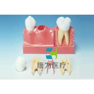 “康为医疗”牙分解模型(4倍大)
